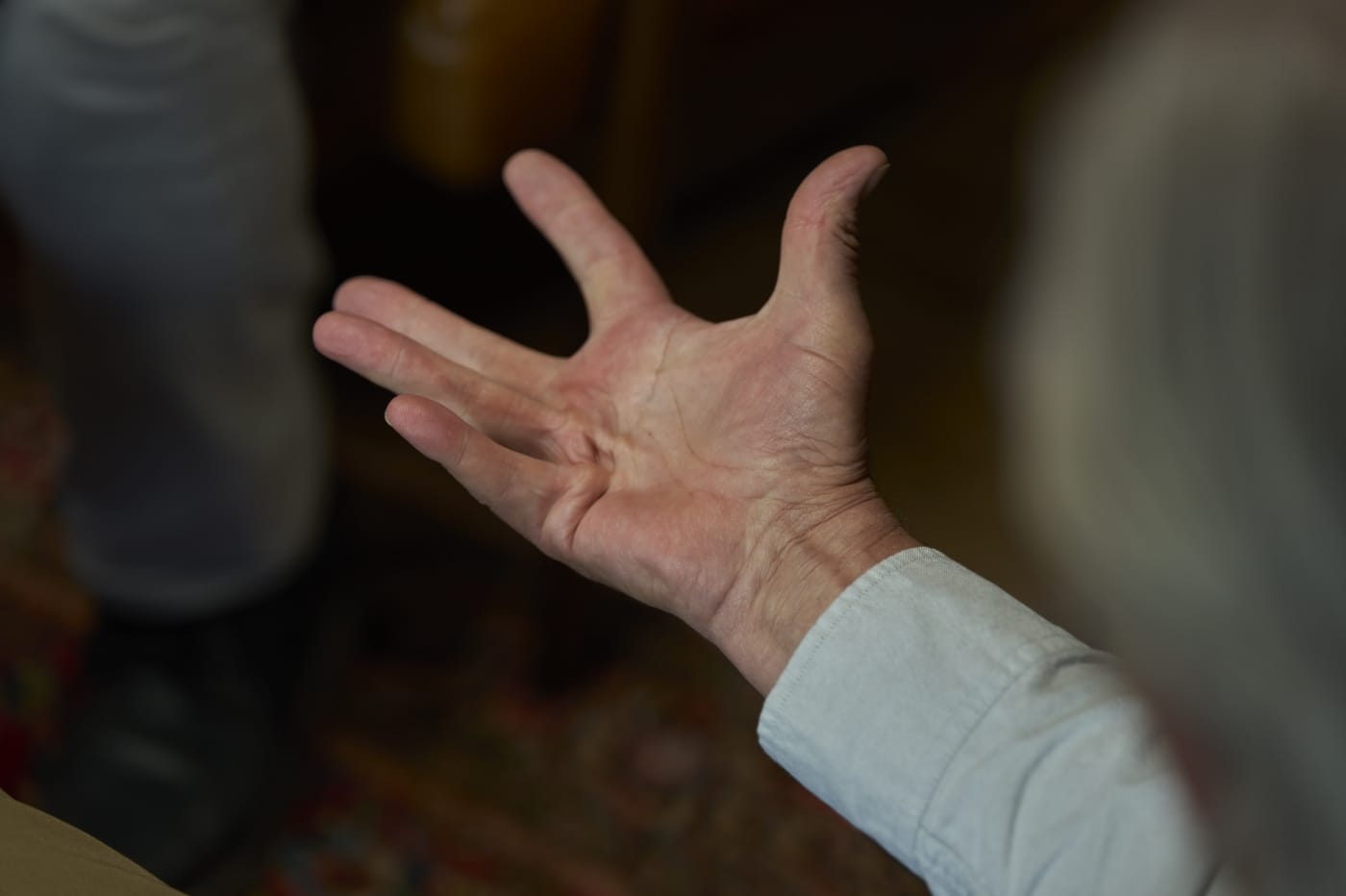 Dupuytren’s contracture patient with open palm