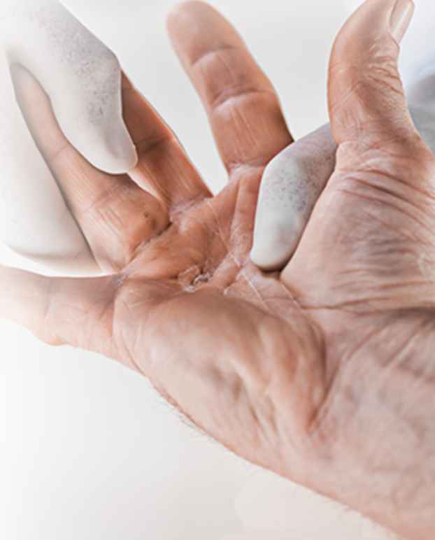 Image showing hand after nonsurgical XIAFLEX® treatment procedure follow-up