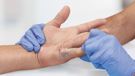 Finger extension after XIAFLEX® injection for a patient with Dupuytren’s contracture in the PIP joint of their fifth finger