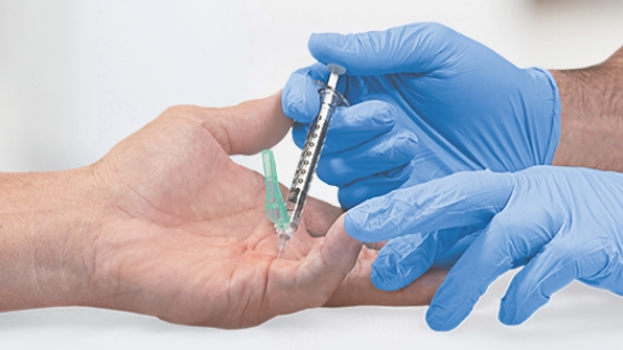 Patient with Dupuytren’s contracture receiving XIAFLEX® injection in their fifth finger