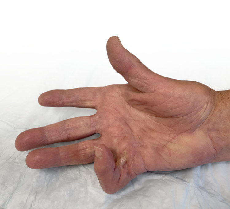 Open hand showing a recurrent Dupuytren’s contracture in the PIP joint of the fifth finger