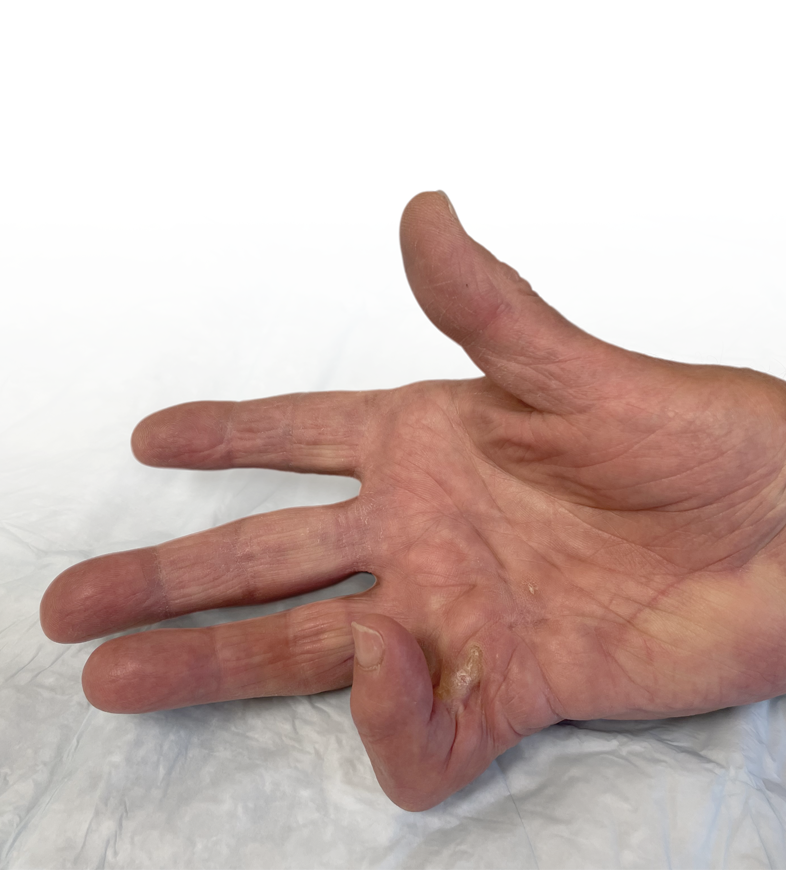 Open hand showing a recurrent Dupuytren’s contracture in the PIP joint of the fifth finger