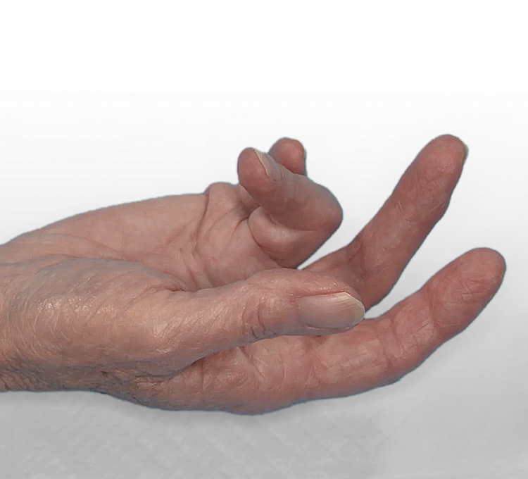 Open hand showing Dupuytren’s contracture in the PIP and MP joints of the fourth finger