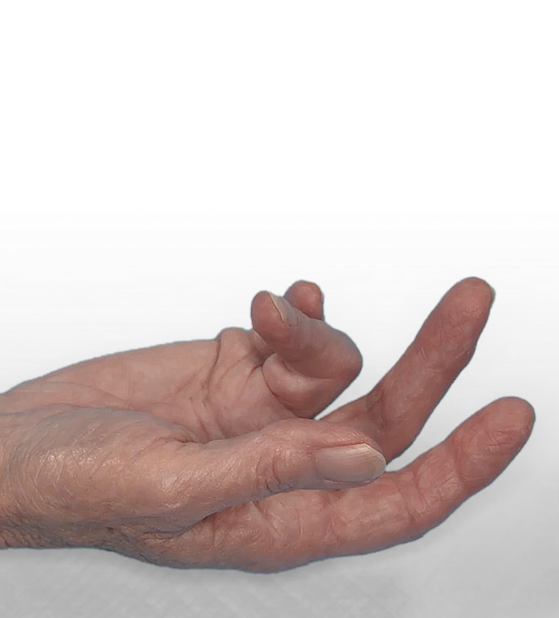 Open hand showing Dupuytren’s contracture in the PIP and MP joints of the fourth finger