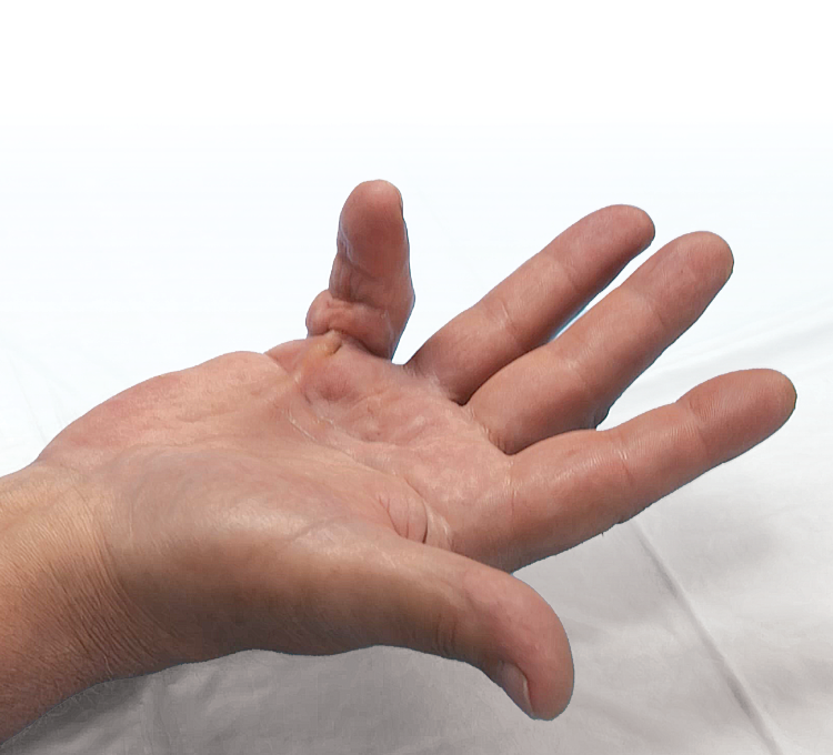 Open hand showing Dupuytren’s contracture in the PIP and MP joints of the fifth finger
