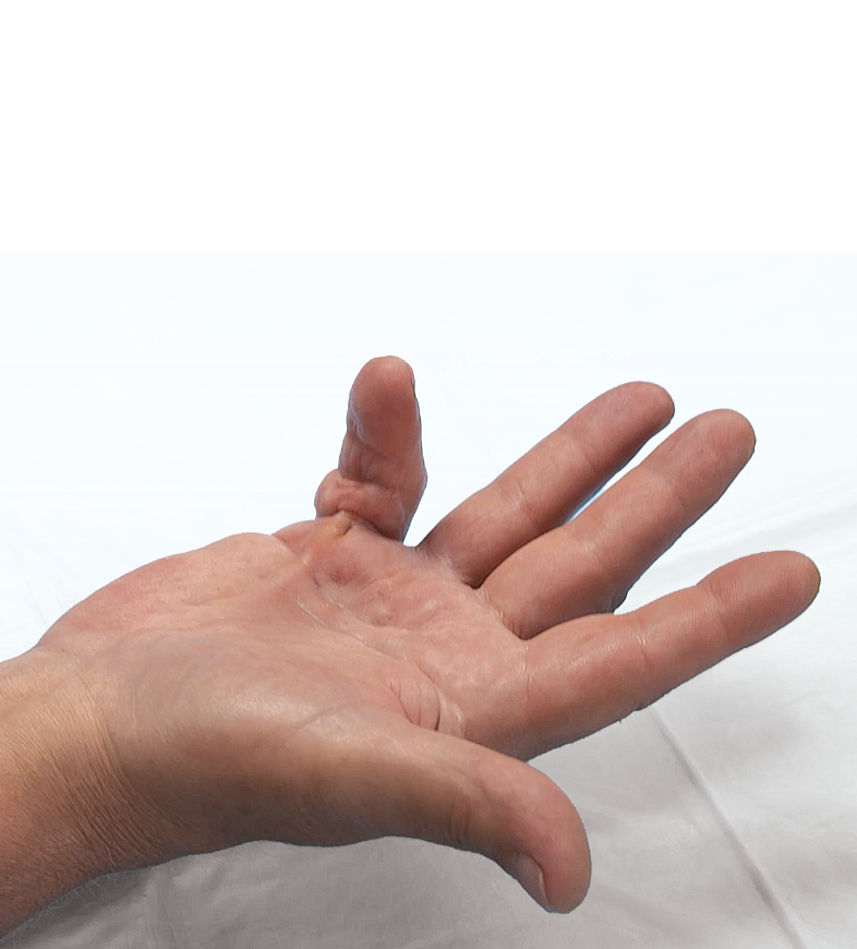 Open hand showing Dupuytren’s contracture in the PIP and MP joints of the fifth finger