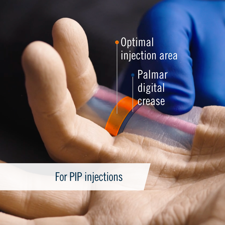 Hand diagram showing the safe zone for optimal XIAFLEX® PIP injection