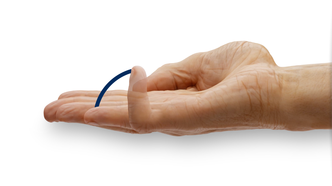 Hand showing range of motion after treatment at 74°