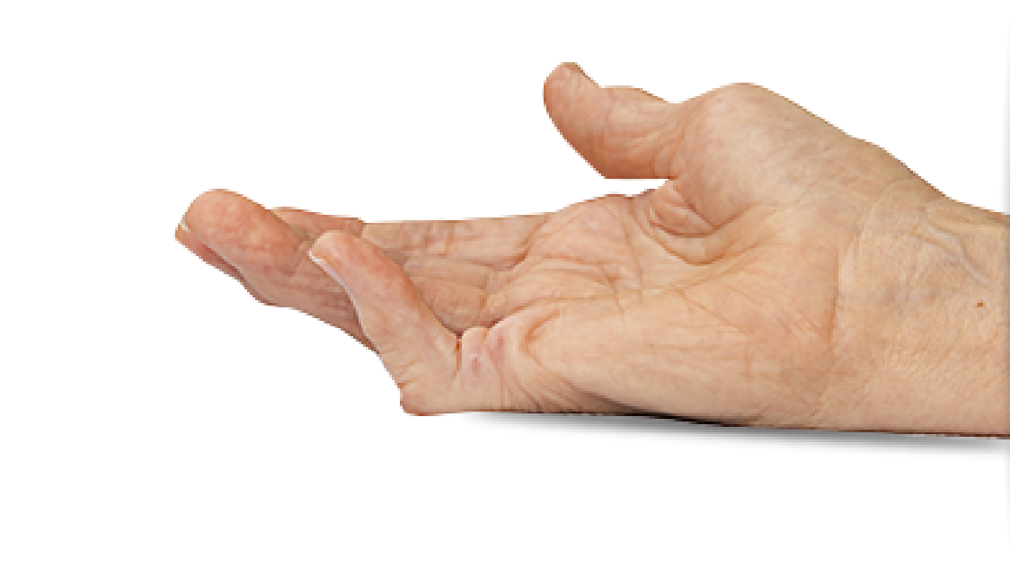 Open palm showing single-joint 45° PIP contracture of the fifth finger