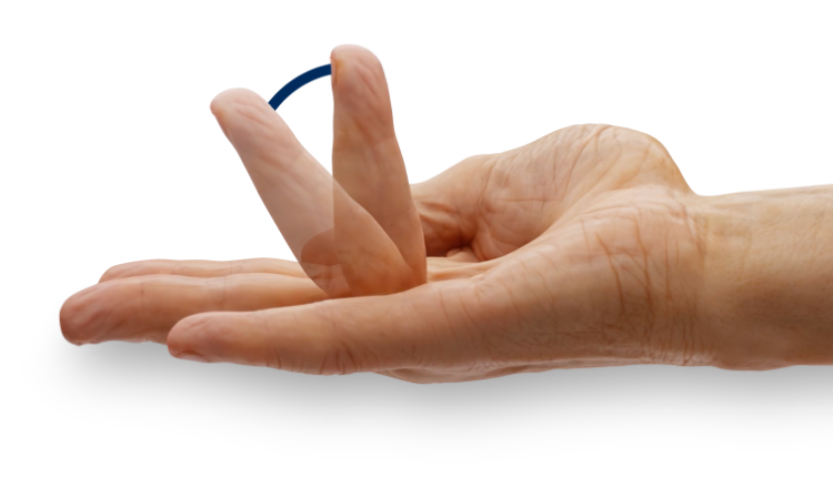 Hand showing range of motion before XIAFLEX® treatment at 42°
