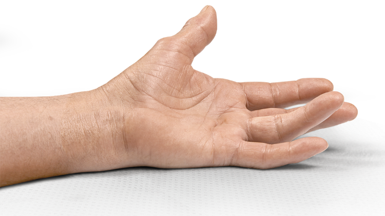 Open palm showing single-joint 30° MP contracture of the fourth finger