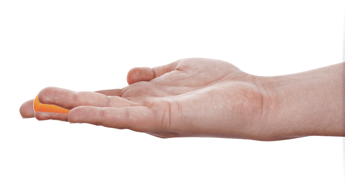 Open palm showing a Dupuytren’s contracture patient with a contracture in the MP joint