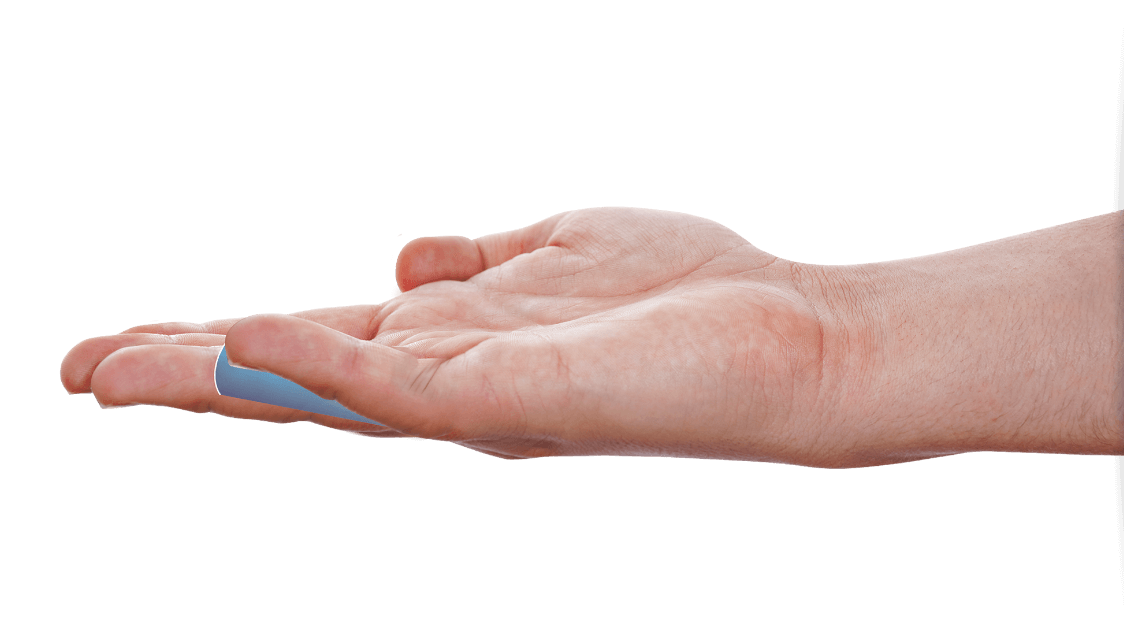 Open palm showing a Dupuytren’s contracture patient with a contracture in the PIP joint