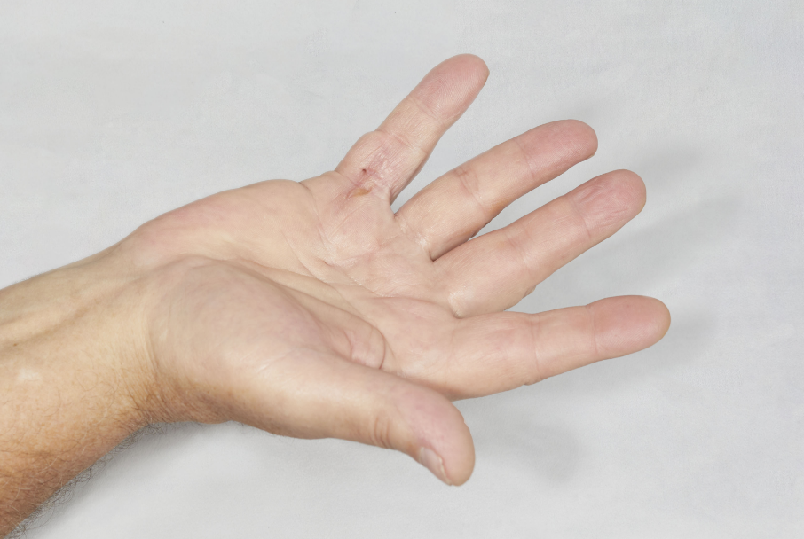 Open palm showing a Dupuytren’s contracture patient with a 2-joint contracture of the fifth finger after XIAFLEX® treatment