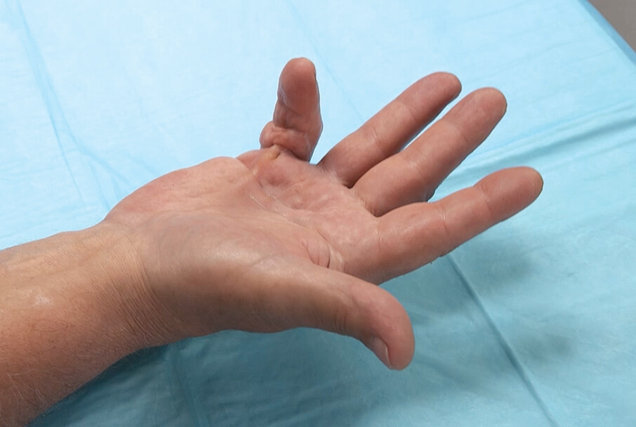 Open palm showing a Dupuytren’s contracture patient with a 2-joint contracture of the fifth finger