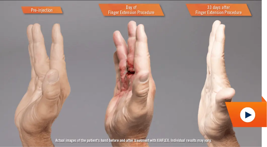 Watch recovery hands video