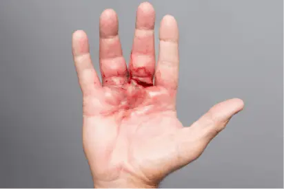 Recovery hand