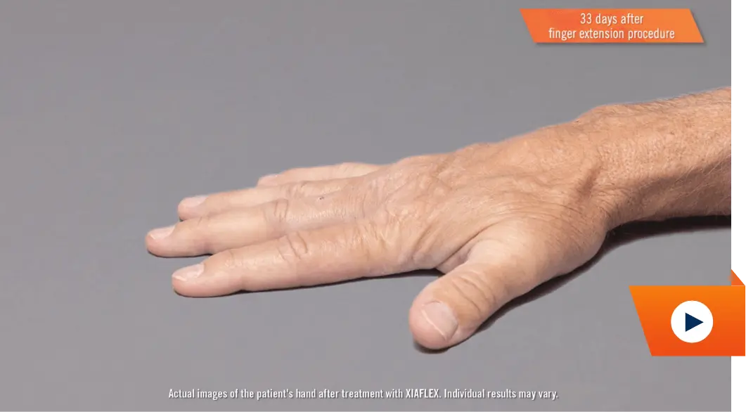 Watch hand treatment result video
