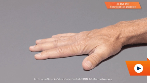 Watch hand treatment result video
