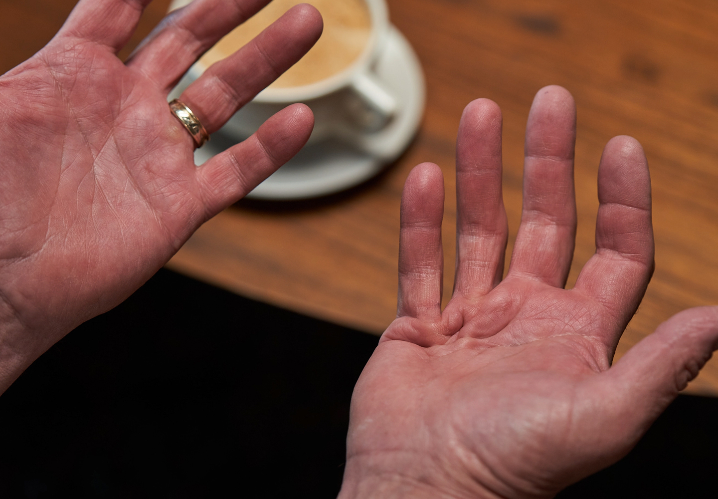 Patient with open palms