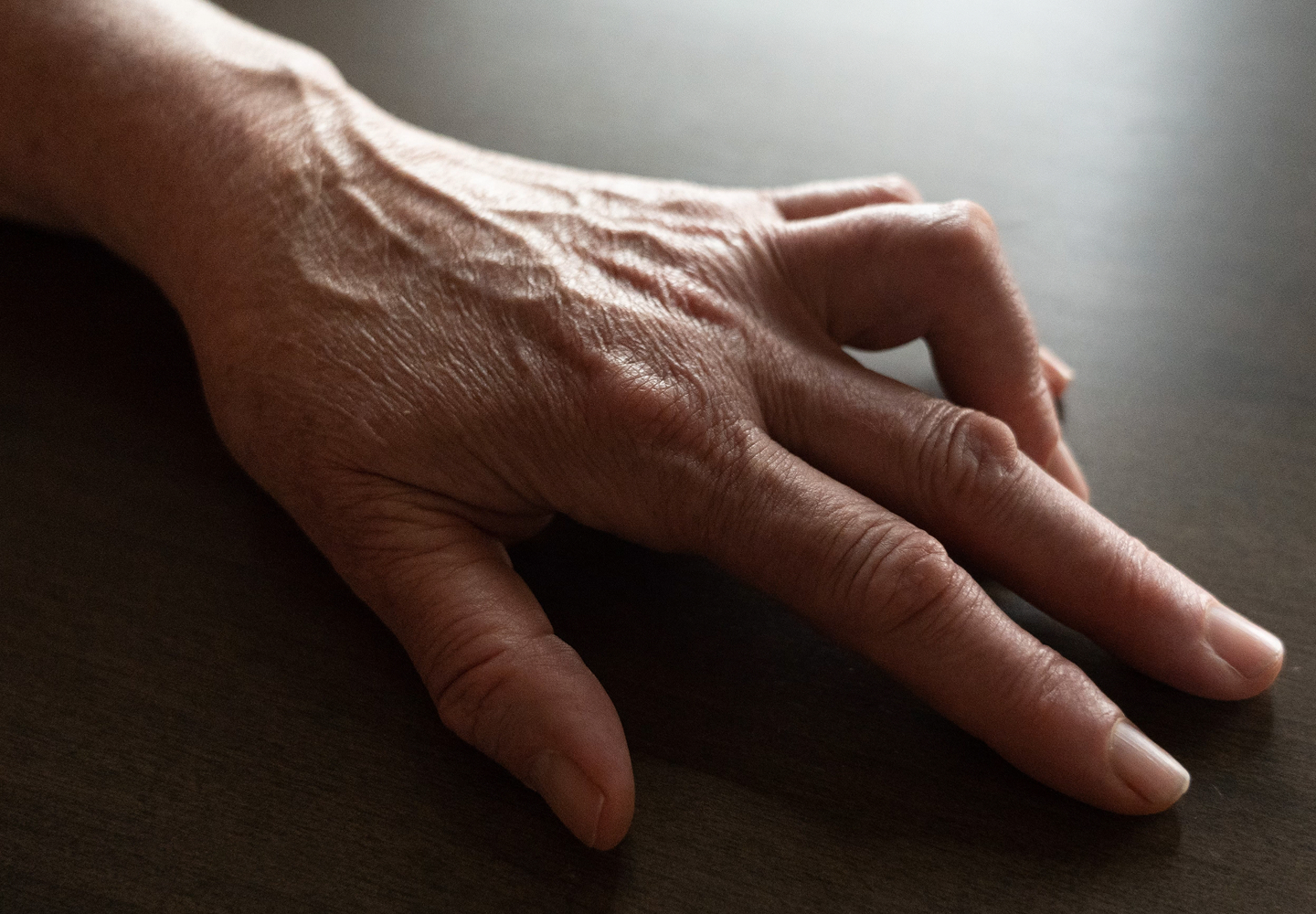 Hand with Dupuytren’s contracture