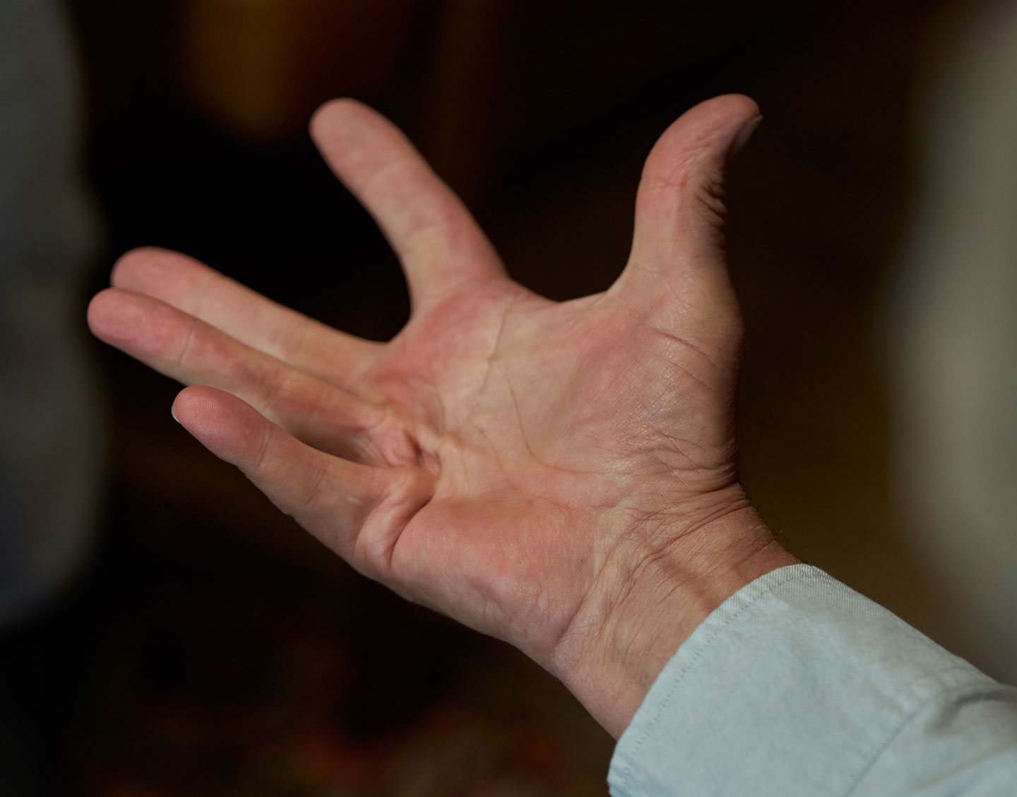 Patient performing the tabletop test for Dupuytren's contracture