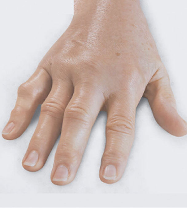 After XIAFLEX: a hand lying flat with all fingers extended
