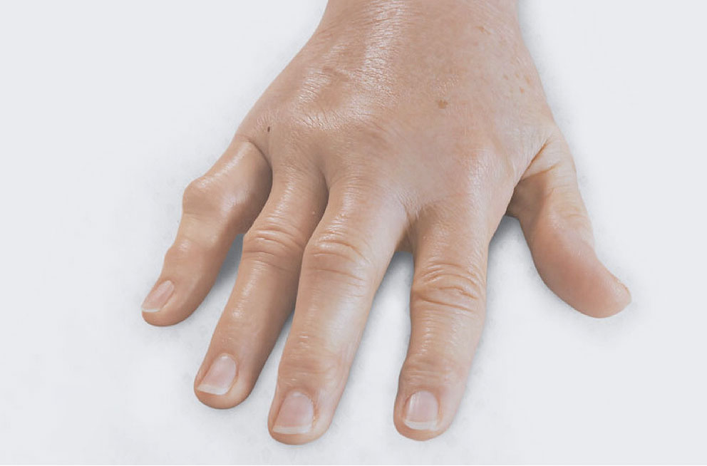 After XIAFLEX: a hand lying flat with all fingers extended