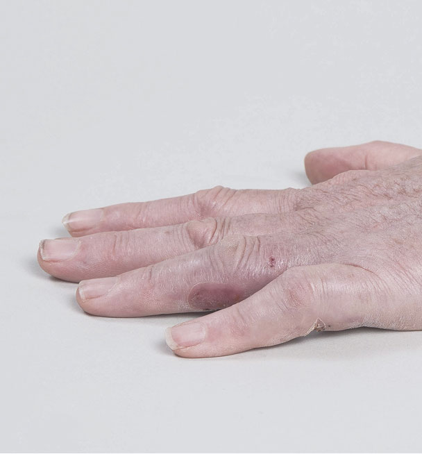 After XIAFLEX: a hand lying flat with all fingers extended