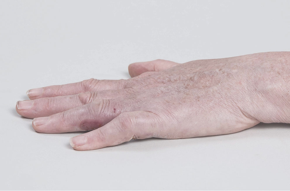 After XIAFLEX: a hand lying flat with all fingers extended