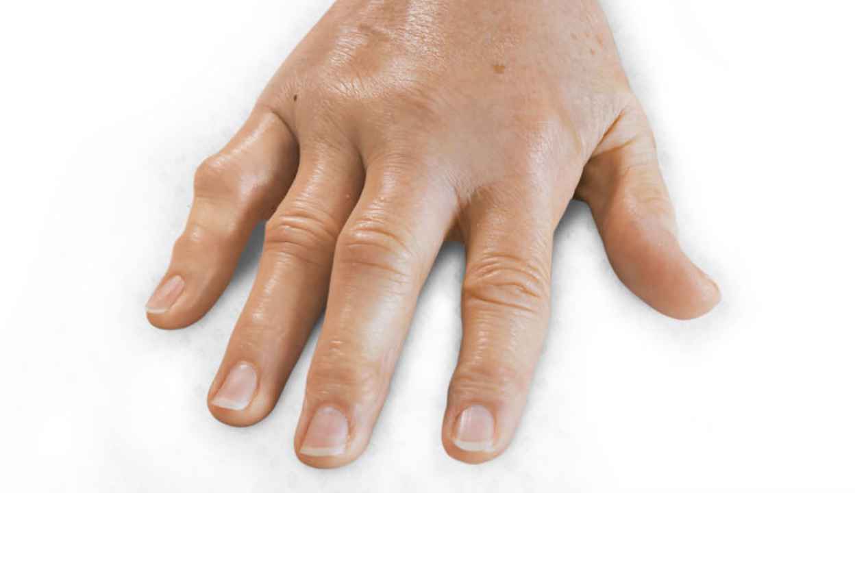 After picture for patient treated with 1 contracture