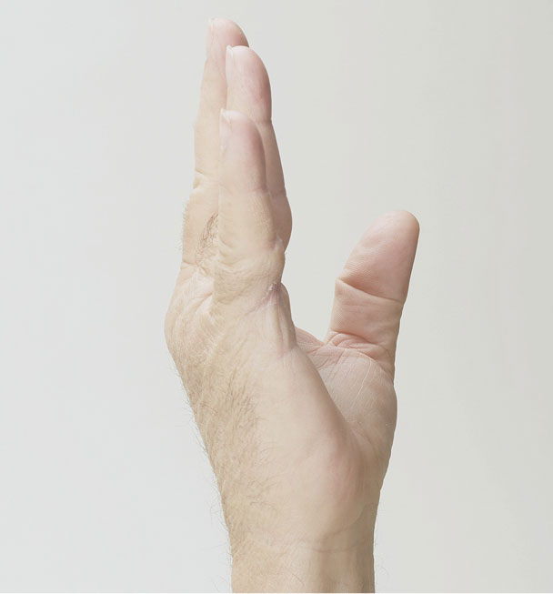 After XIAFLEX: a hand lying flat with all fingers extended