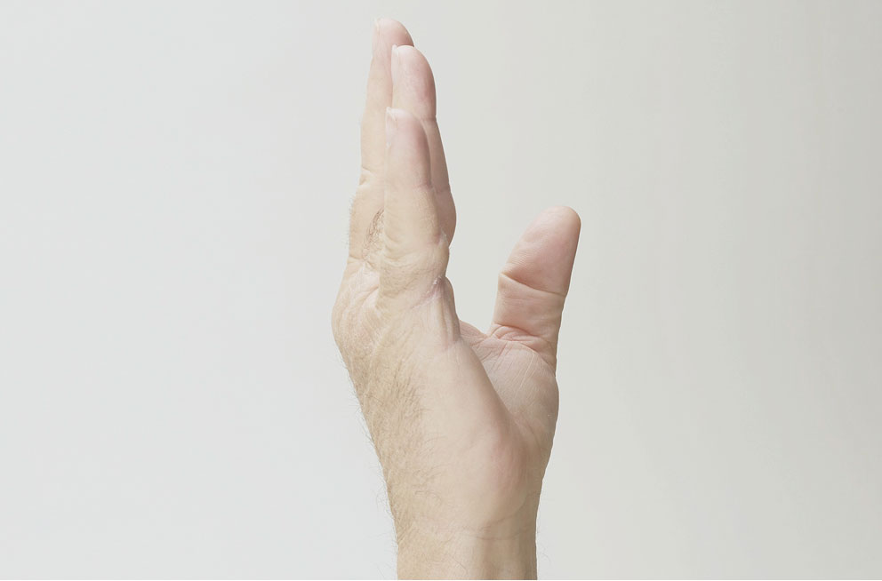 After XIAFLEX: a hand lying flat with all fingers extended
