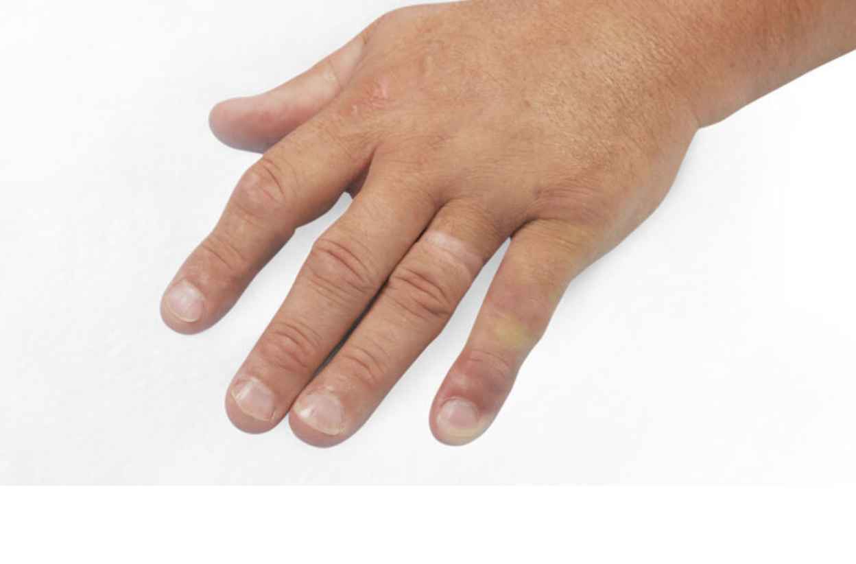 After picture for patient treated with 2 contractures on the same hand