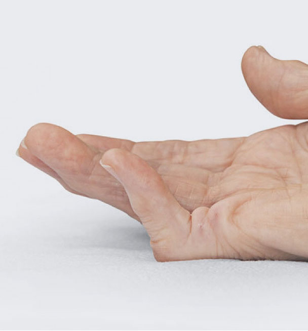 Before XIAFLEX: a hand with a contracture in the pinky finger