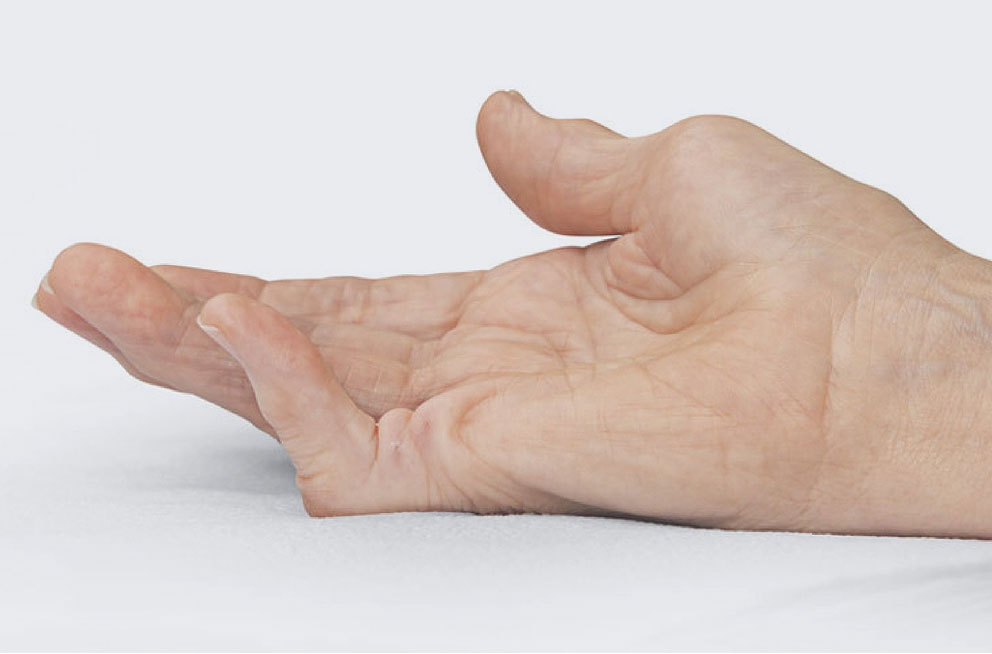 Before XIAFLEX: a hand with a contracture in the pinky finger