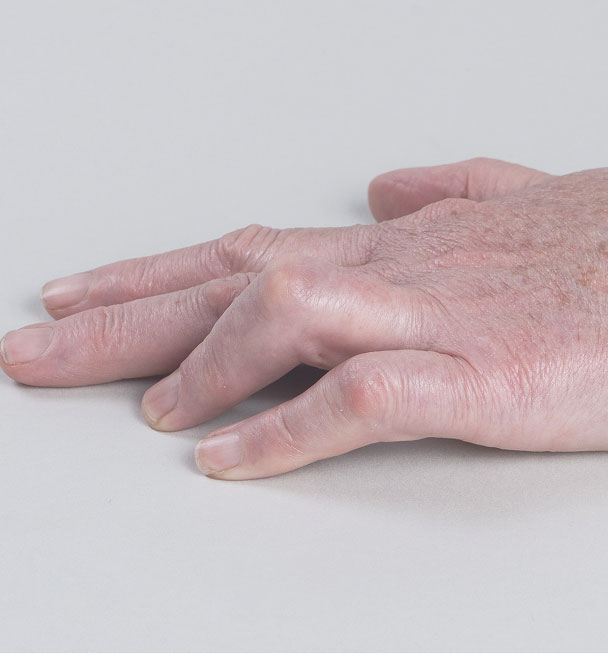 Before XIAFLEX: a hand with contractures in ring and pinky fingers
