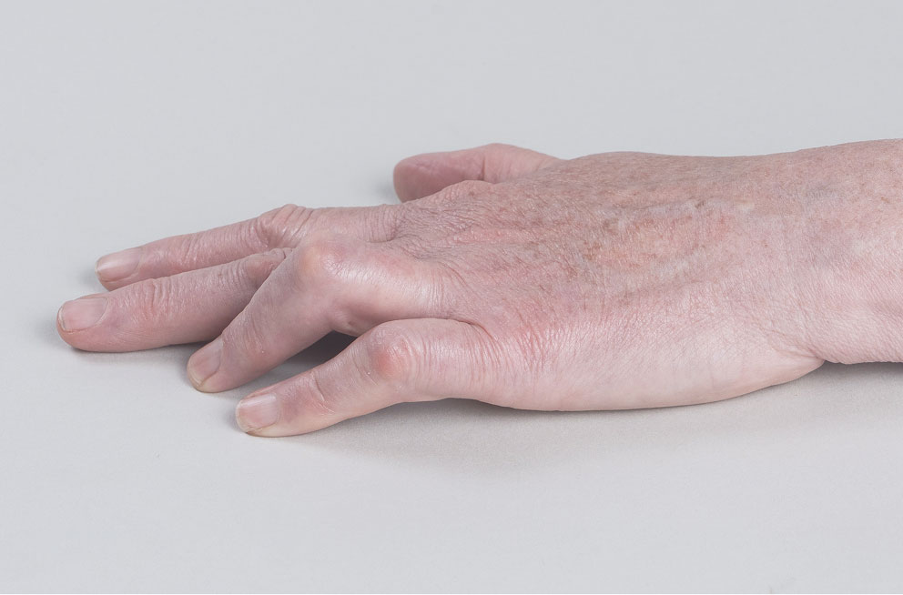 Before XIAFLEX: a hand with contractures in ring and pinky fingers