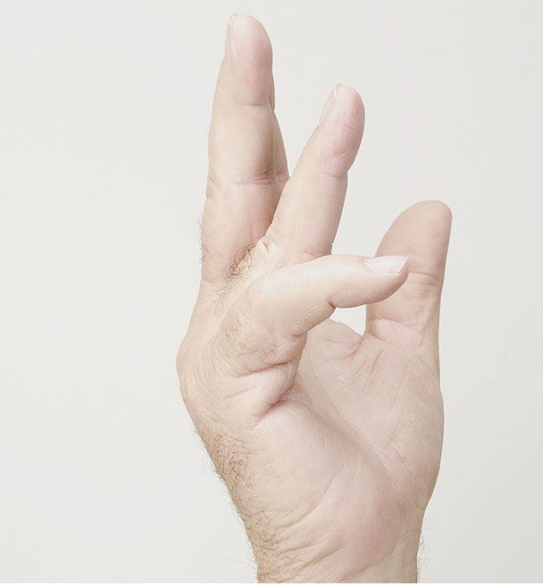 Before XIAFLEX: a hand with contractures in the pinky finger