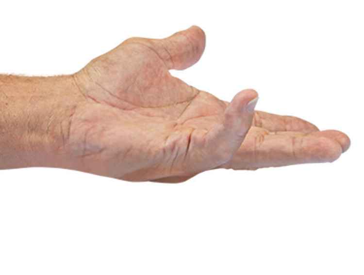 Before picture for patient treated with 2 contractures on the same hand