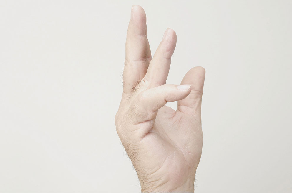 Before XIAFLEX: a hand with contractures in the pinky finger