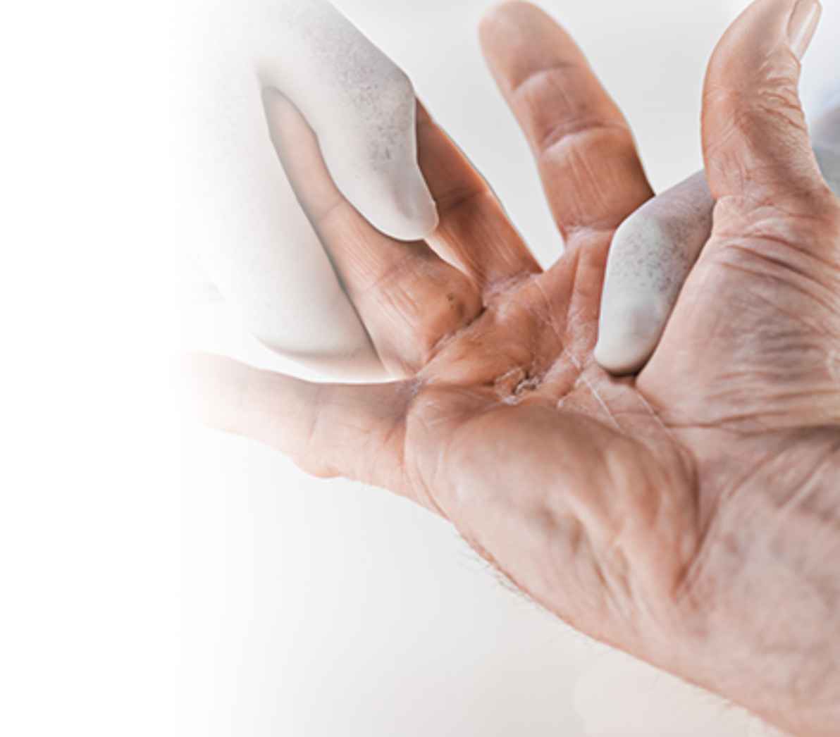 Image showing hand after nonsurgical XIAFLEX® treatment procedure follow-up